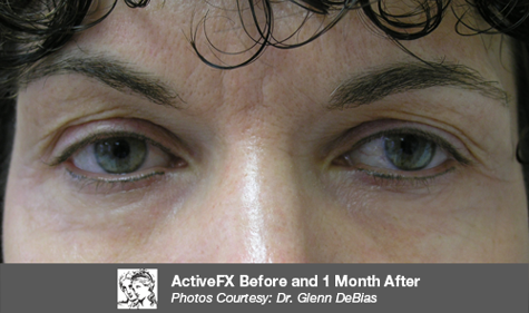 After ActiveFX treatment
