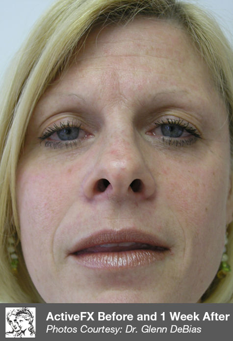 After ActiveFX treatment