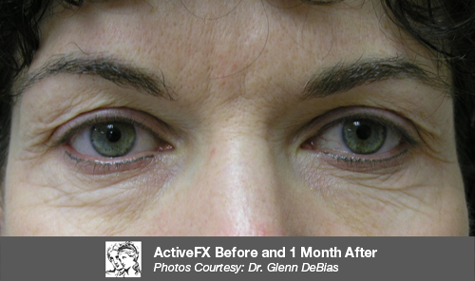 Before ActiveFX treatment