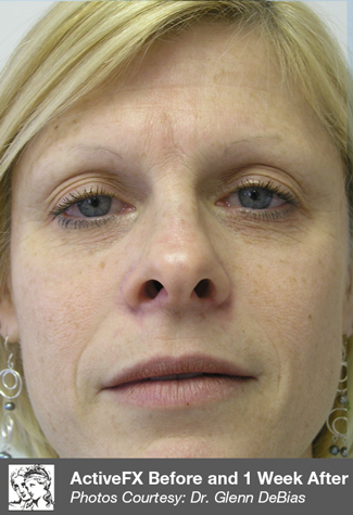 Before ActiveFX treatment