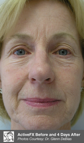 Before scar treatment